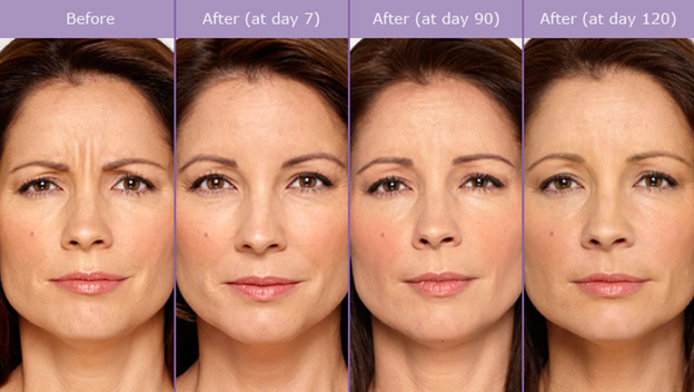 before and after botox treatment in pineville nc