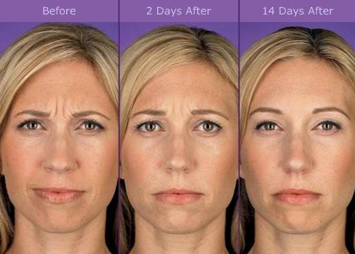 before and after botox treatment pineville nc