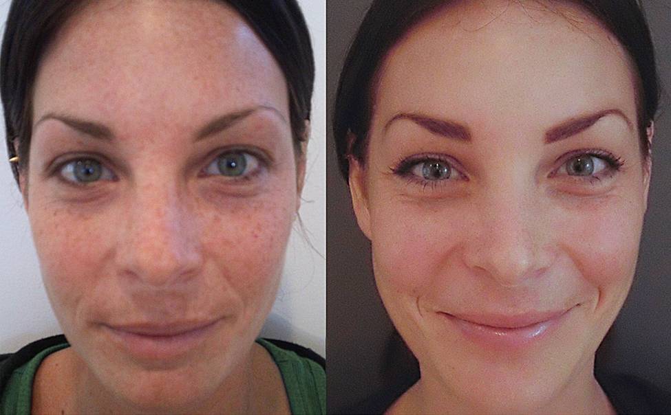 before and after chemical peel in Pineville NC