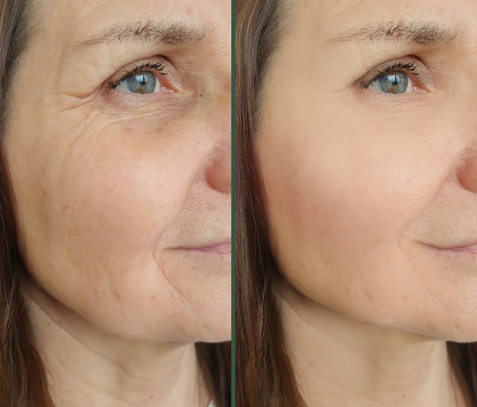 before and after chemical peel in Pineville
