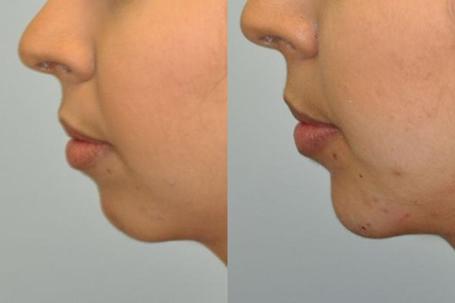 Chin augmentation with dermal fillers in Pineville, NC