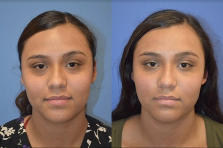Clearing face dark circles with dermal fillers in Pineville, NC