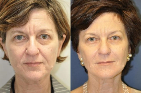 Facial Injectables in Pineville, NC