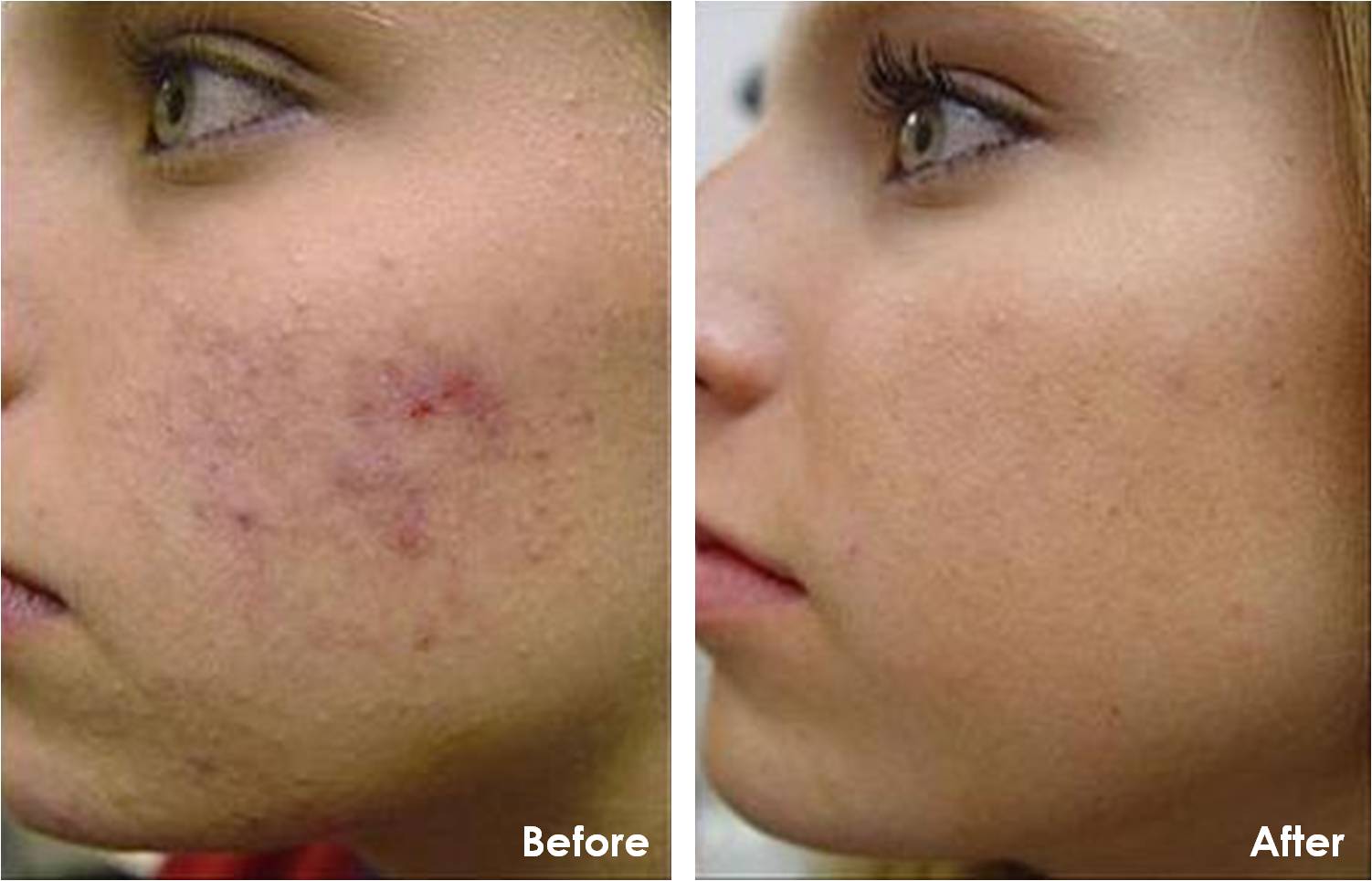 Refresh Your Skin with a Chemical Peel  Carolina Medical Associates