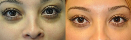 under eye volume with dermal fillers in Pineville, NC